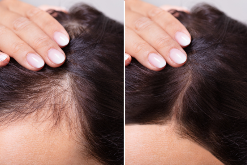 Hair Loss in Atlanta - Diagnosis and Treatment by a Dermatologist