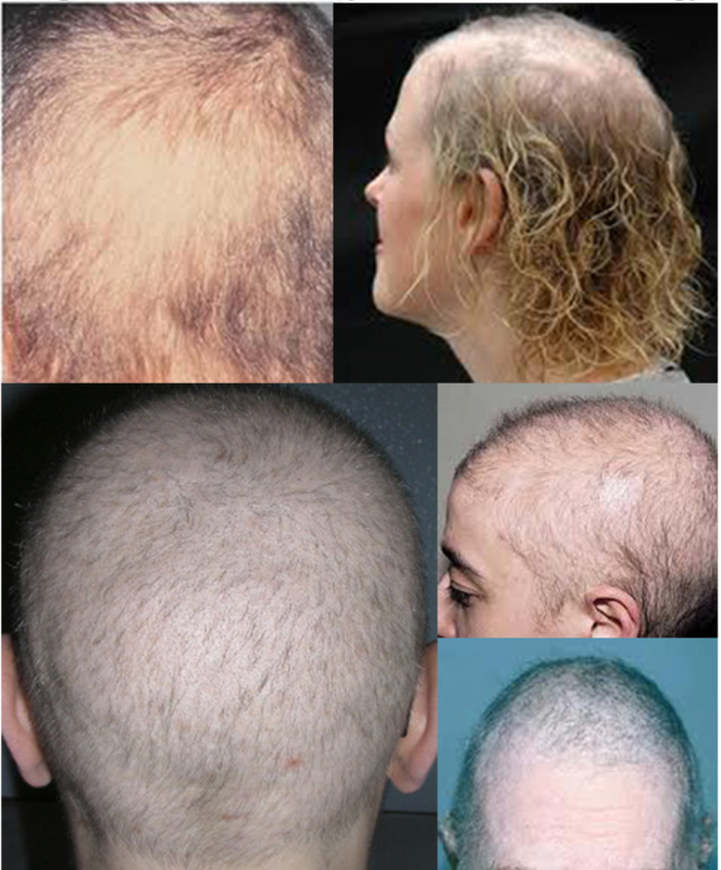 Is Anagen Effluvium Responsible for Your Hair Loss? Find Out Here