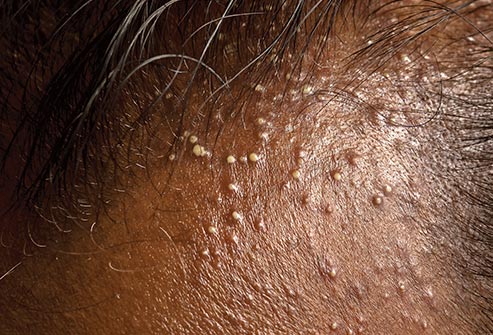 Scalp Folliculitis –What It Is & What You Can Do About It?
