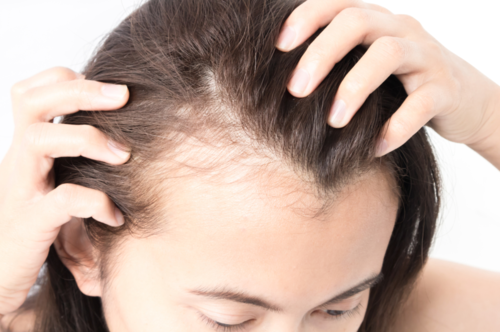 PCOS Hair Loss: How to Fight Back