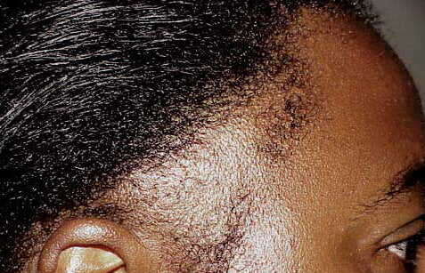 What can you do about Traction Alopecia?