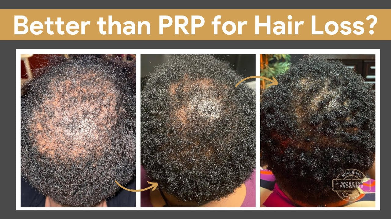 The PRP alternative that gets great hair growth results!