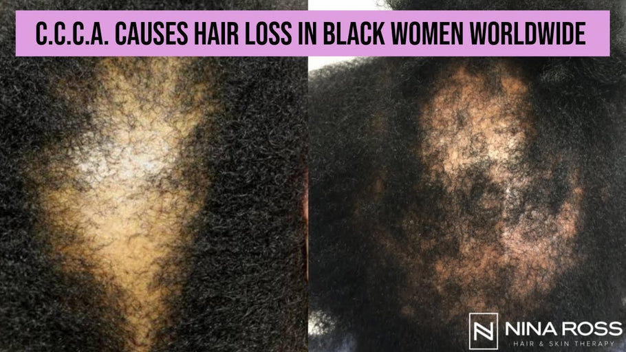 What is CCCA? Central Centrifugal Cicatricial Alopecia is a Common Cause of Hair Loss in Black Women