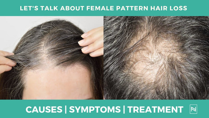 Let's Talk About Female Pattern Baldness | Female Hair Loss Treatment | @NinaRossATL