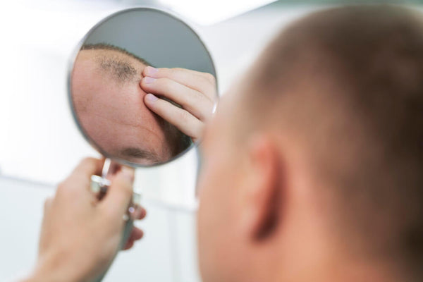 Your Guide to Hair Loss Treatment for Men