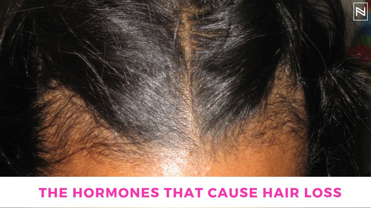 Can a Hormonal Imbalance Cause Hair Loss? | Hormonal Hair Loss Explained | @NinaRossATL