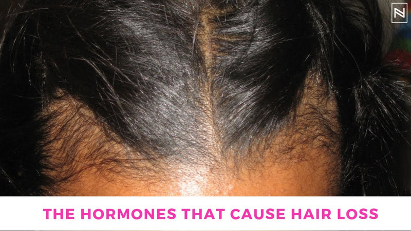 Can a Hormonal Imbalance Cause Hair Loss? | Hormonal Hair Loss Explained | @NinaRossATL