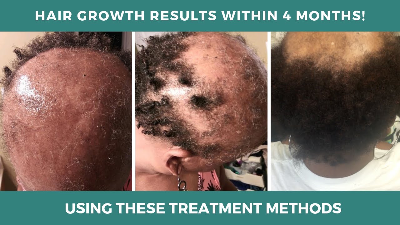 Mesotherapy for Hair Loss Before & After Results | Platelet Rich Plasma for Hair Loss