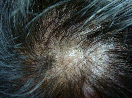 Lichen Planopilaris: The Silent Hair Loss Threat