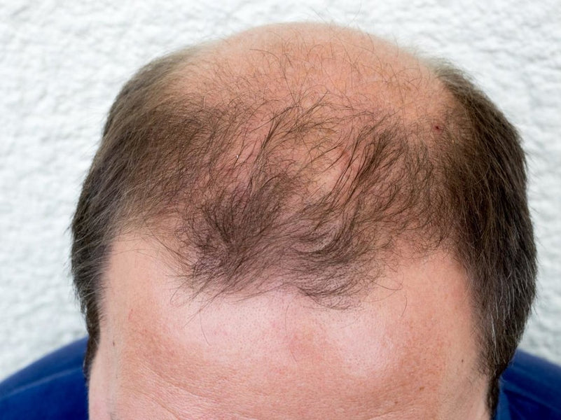Is Your Receding Hairline Really Male Pattern Baldness?
