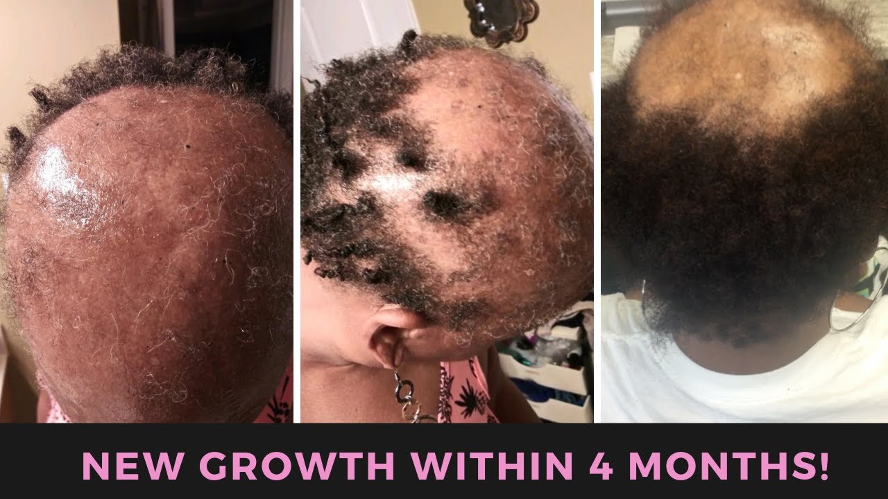 Our Secret for Hair GROWTH! | Mesotherapy for Hair | Before & After