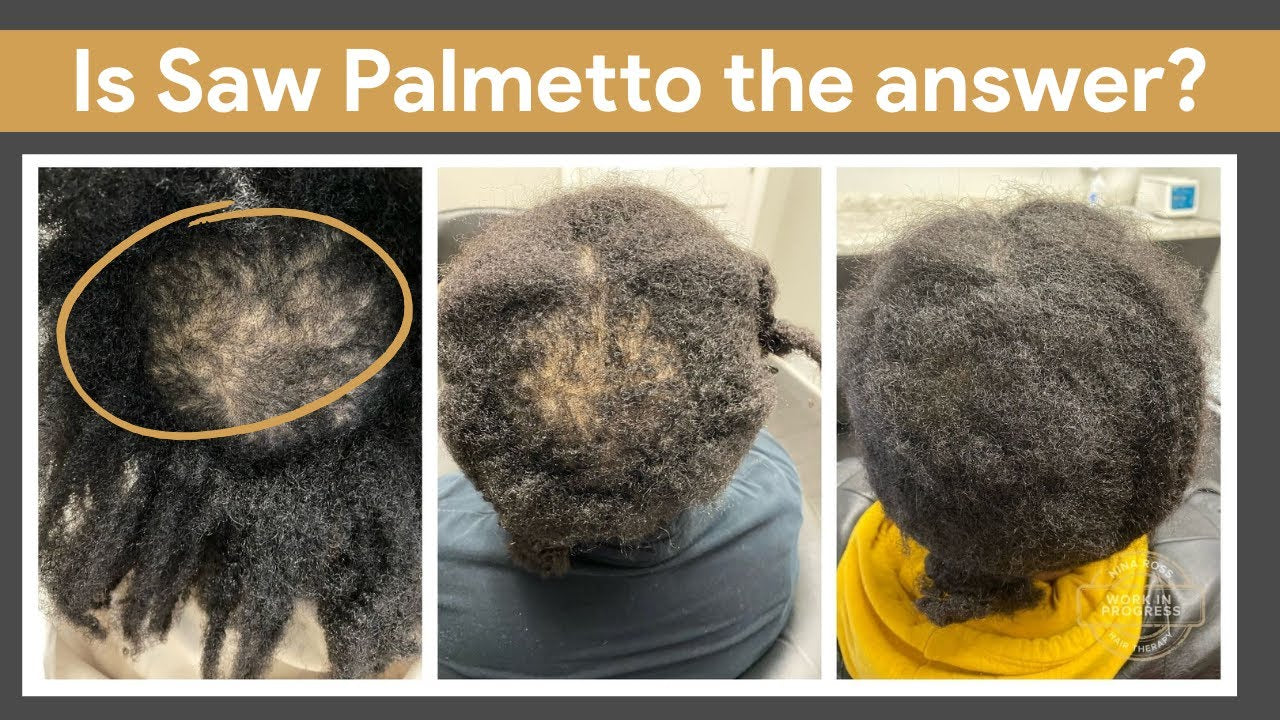 Saw Palmetto: A Game Changer For Hair Loss