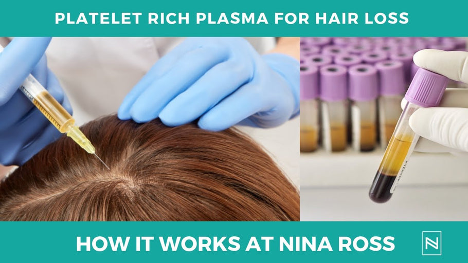 PRP For Hair Loss | Why We Get Better Results | PRP Treatment