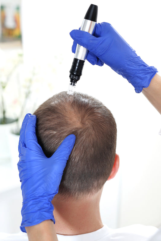 Here’s How Microneedling Prevents Hair Loss