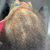 4th Client's scalp before hair growth treatment
