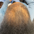 4th Client's scalp progress after hair growth treatment
