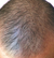 6th Client's scalp after hair growth treatment